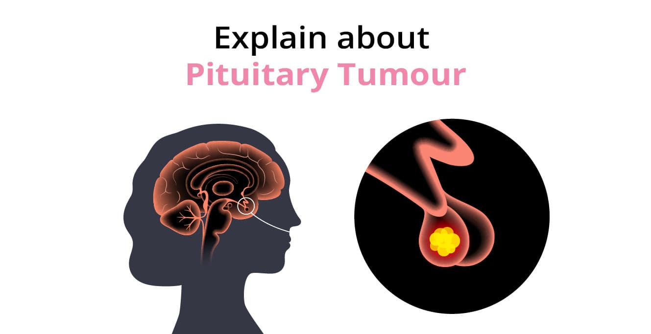Pituitary Tumors: Everything You Need to Know