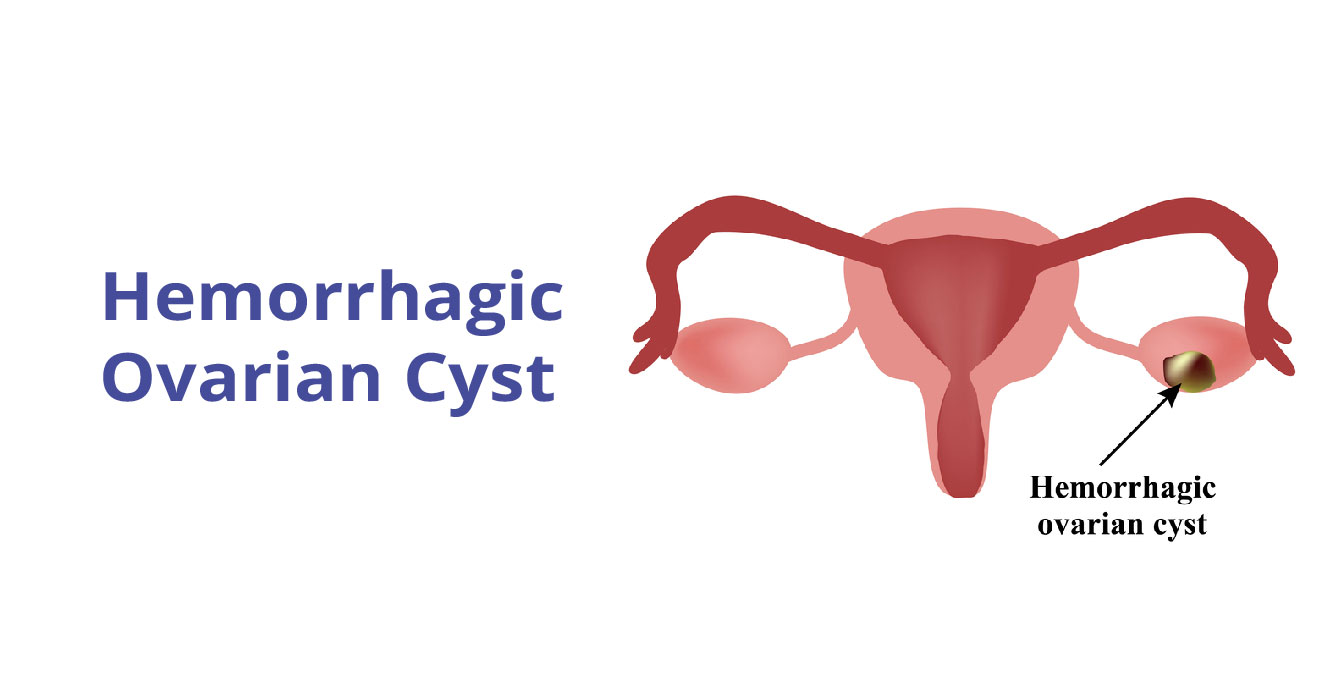 What is a hemorrhagic ovarian cyst