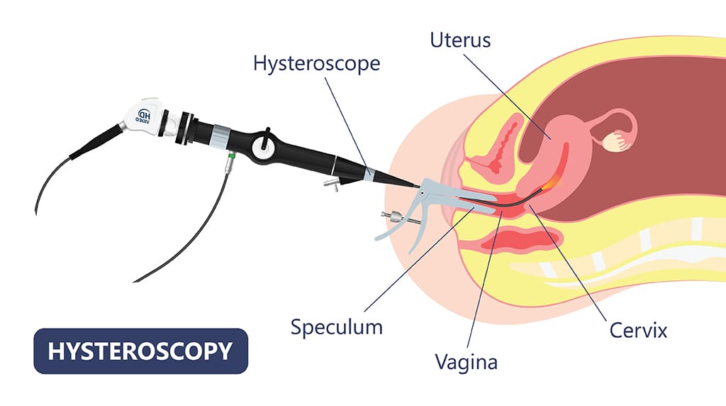 How does a uterine septum form