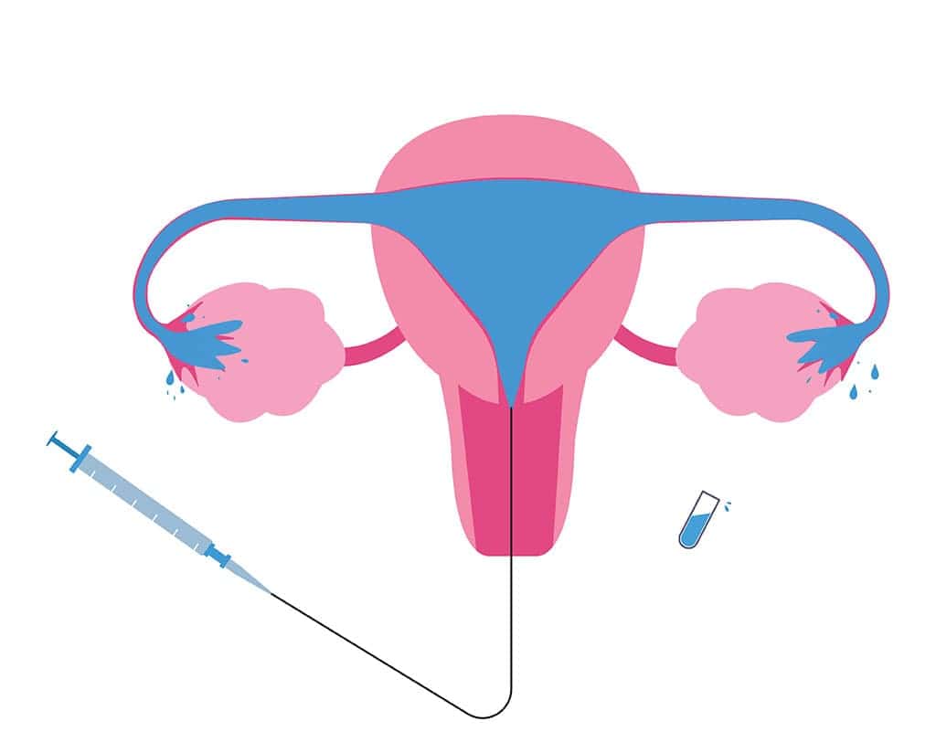 Hysterosalpingogram (HSG ٽيسٽ)