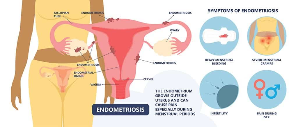 Causes for menstrual cramps (Dysmenorrhea)