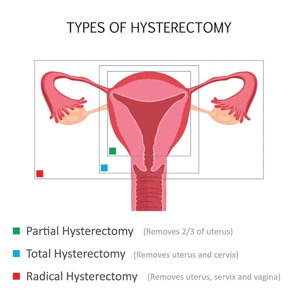 types of Secondary dysmenorrhea treatment