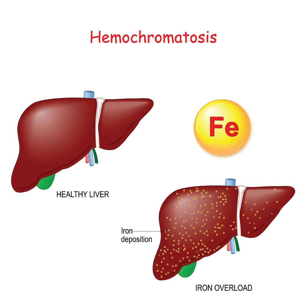 ثانوي hemochromatosis