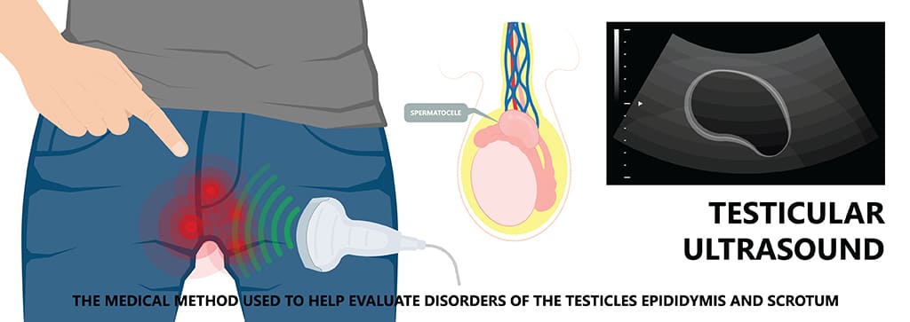 Spermatocele: Causes, Symptoms, Diagnosis & Treatment