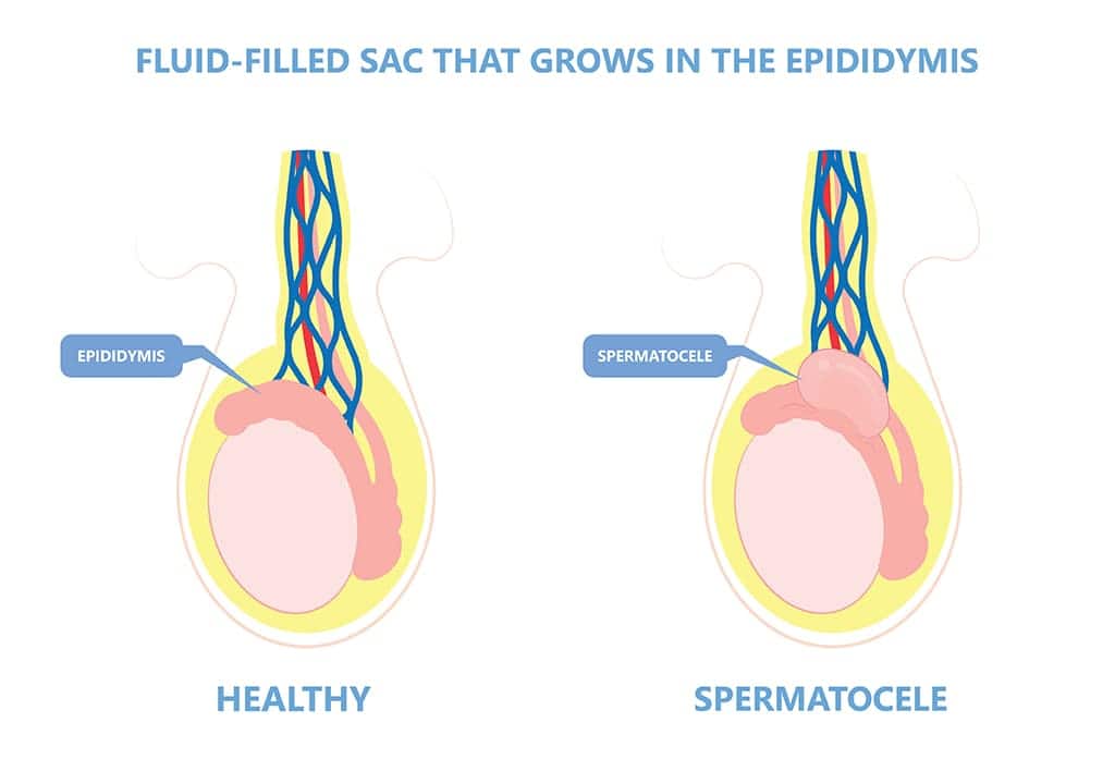 Spermatocele Symptoms