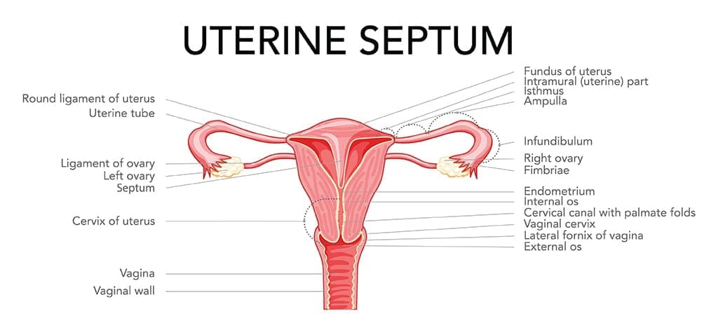 uterine septum جي نشانين جي نشاندهي