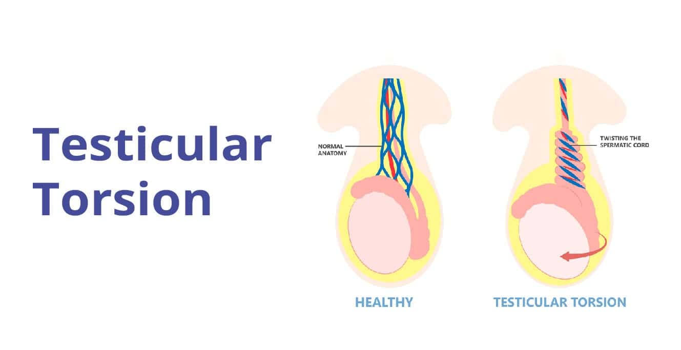 Testicular Torsion ڇا آهي؟