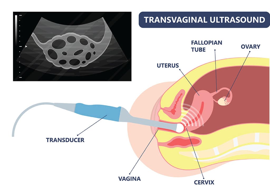 Transvaginal ultrasound scanning