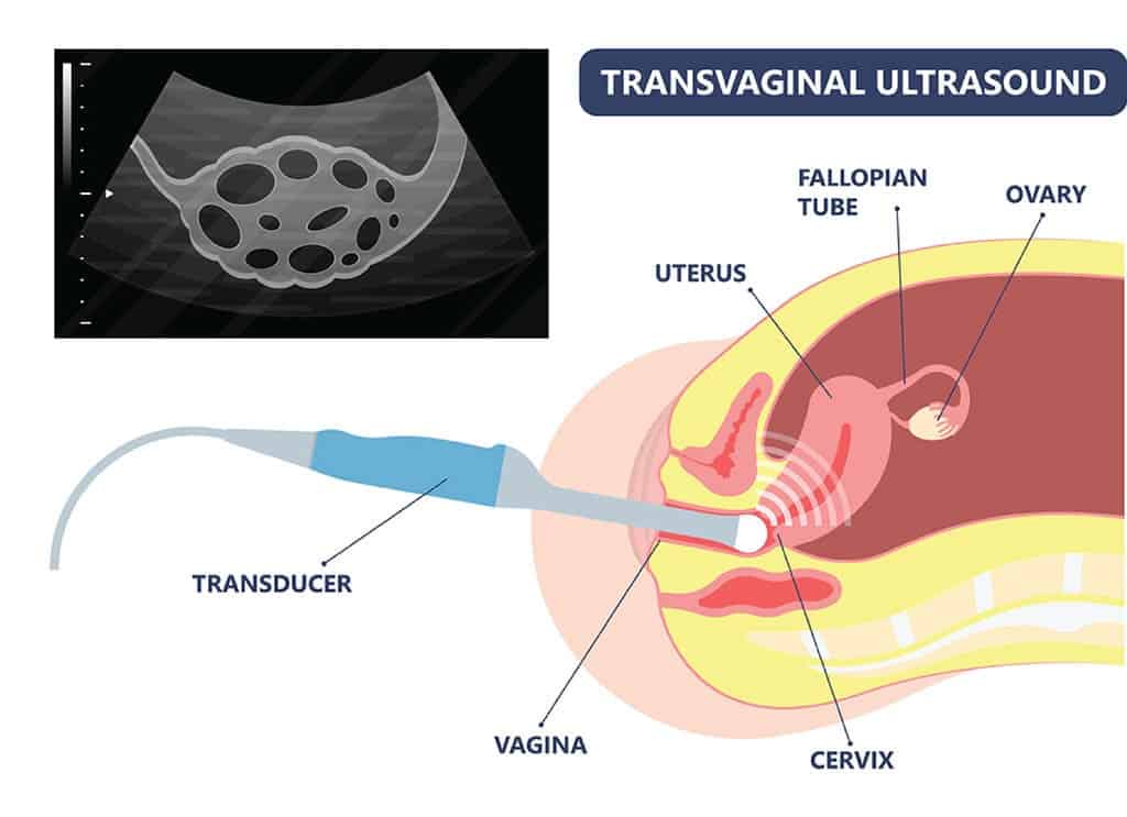 Transvaginal ultrasound scanning