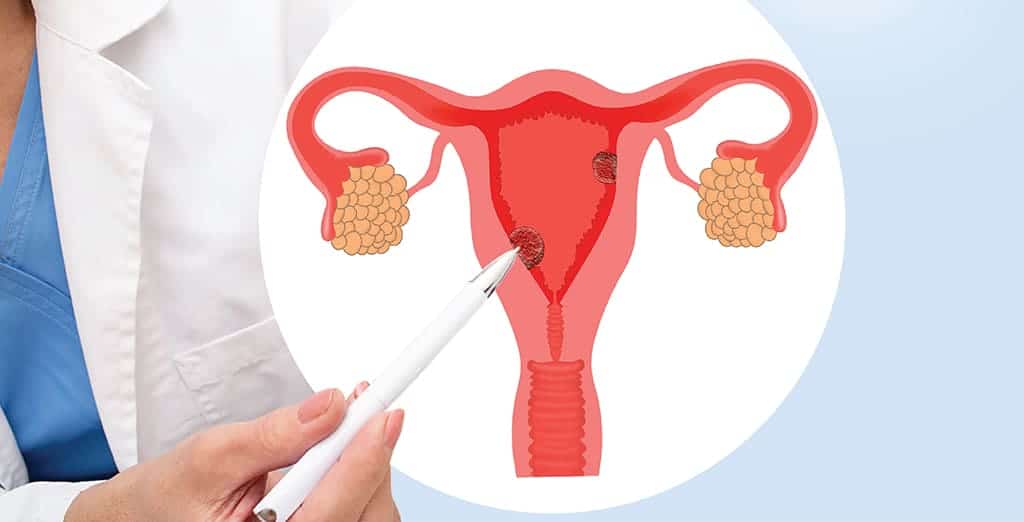 Treatment of polyps that reduce fertility