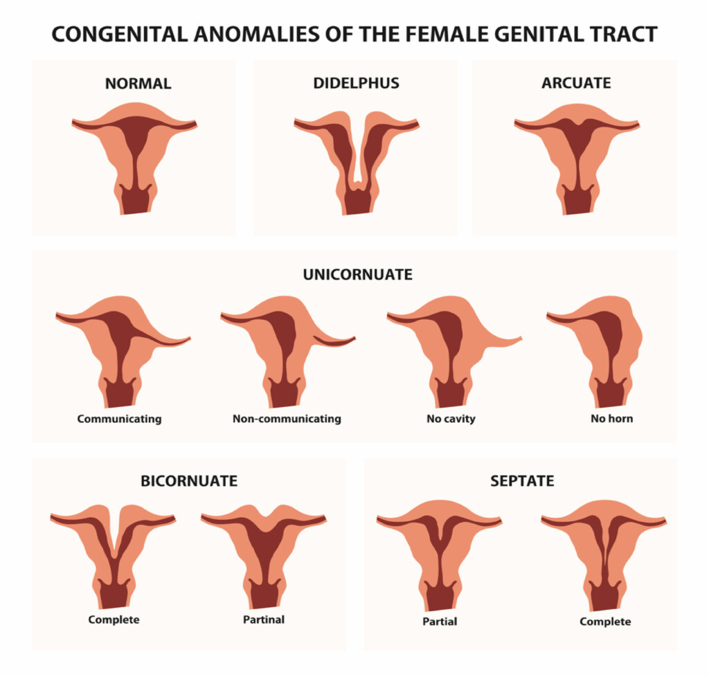 Types of unicornuate uterus