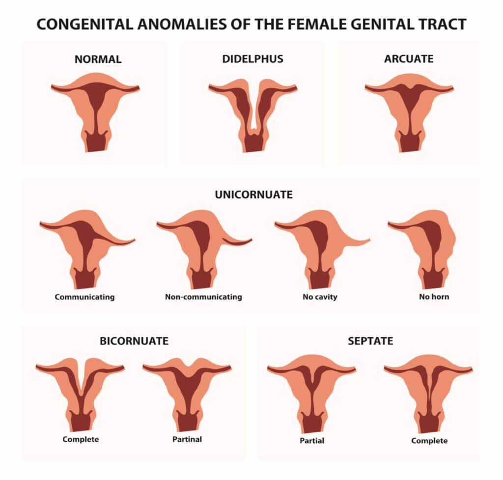 unicornuate uterus جا قسم