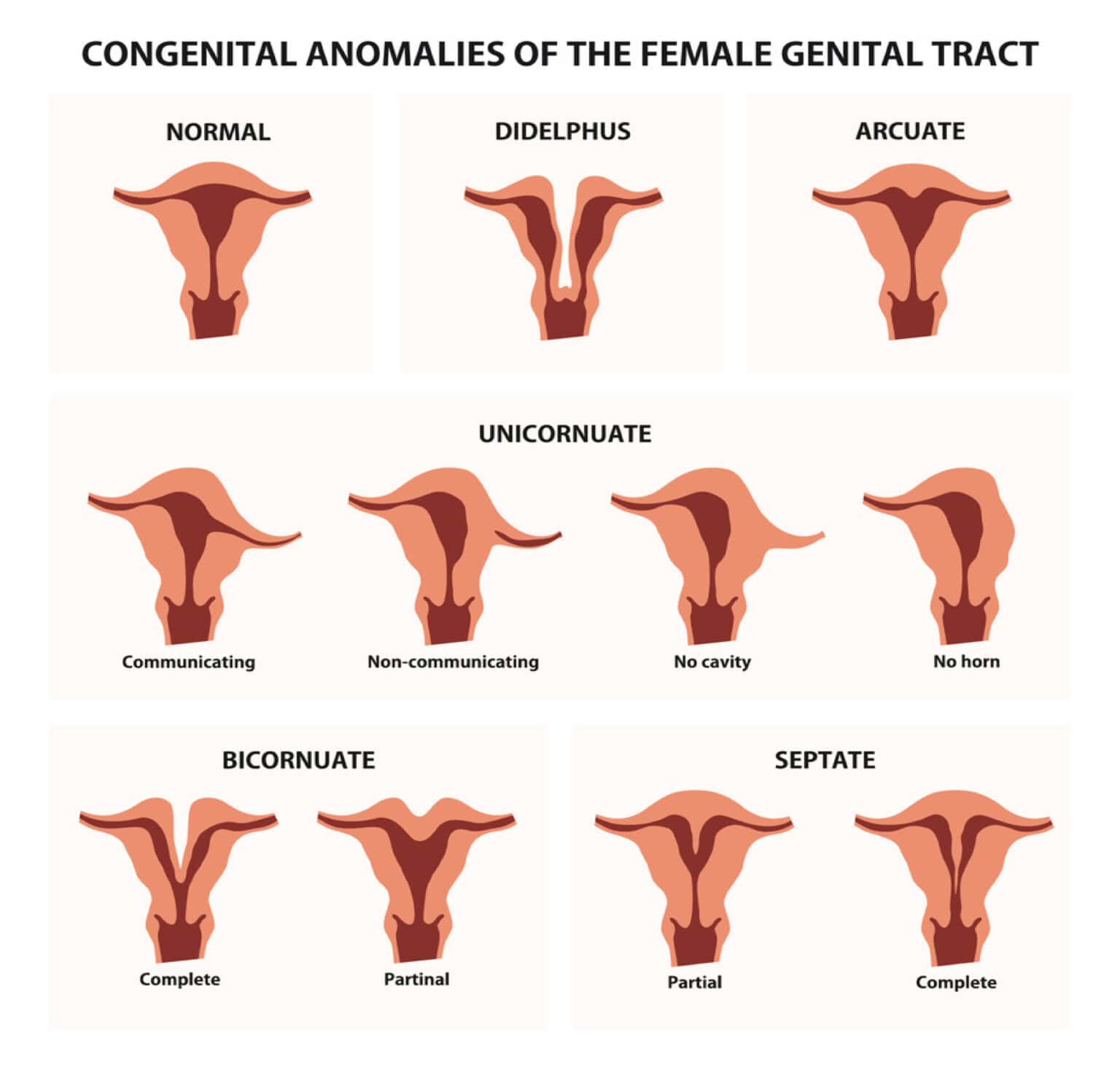 Unicornuate Uterus Treatment, Causes & its Type | Birla Fertility & IVF