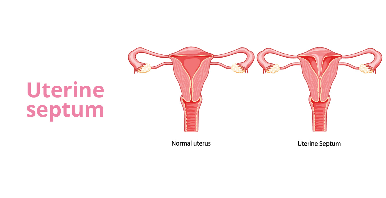 Septum Removal: Everything to Know About Your Uterine Health