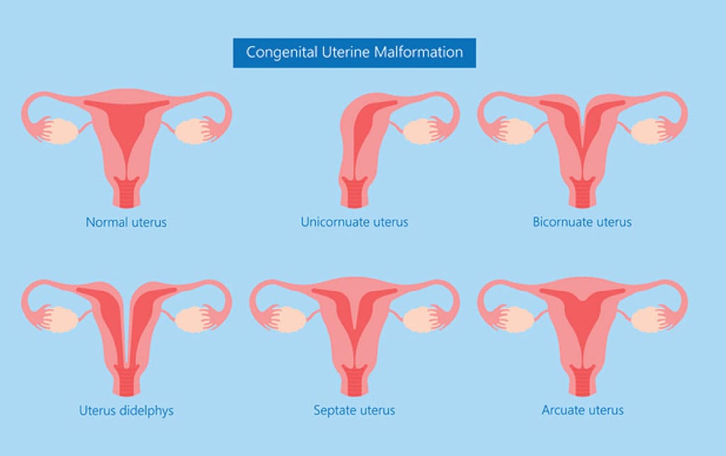 Uterine abnormalities