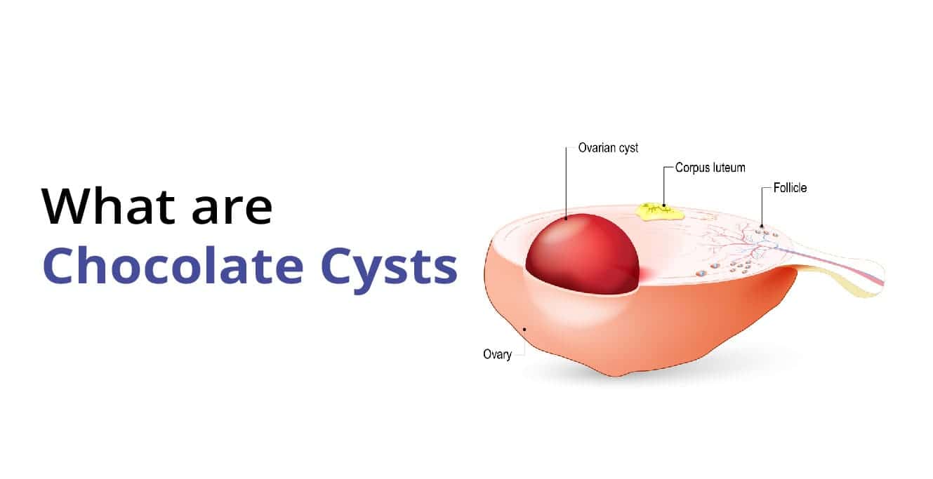 Chocolate Cysts : Causes, Symptoms & Treatment