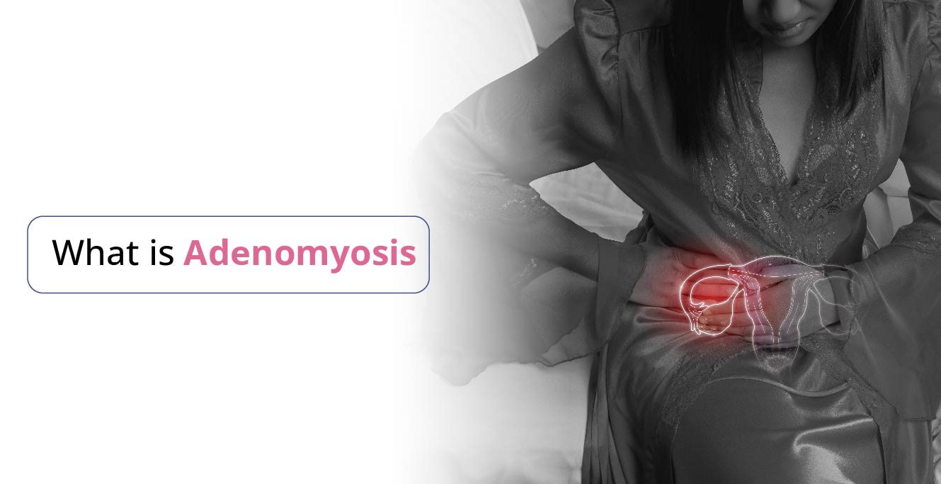 What is Adenomyosis? Causes, Symptoms, Diagnosis and Treatment