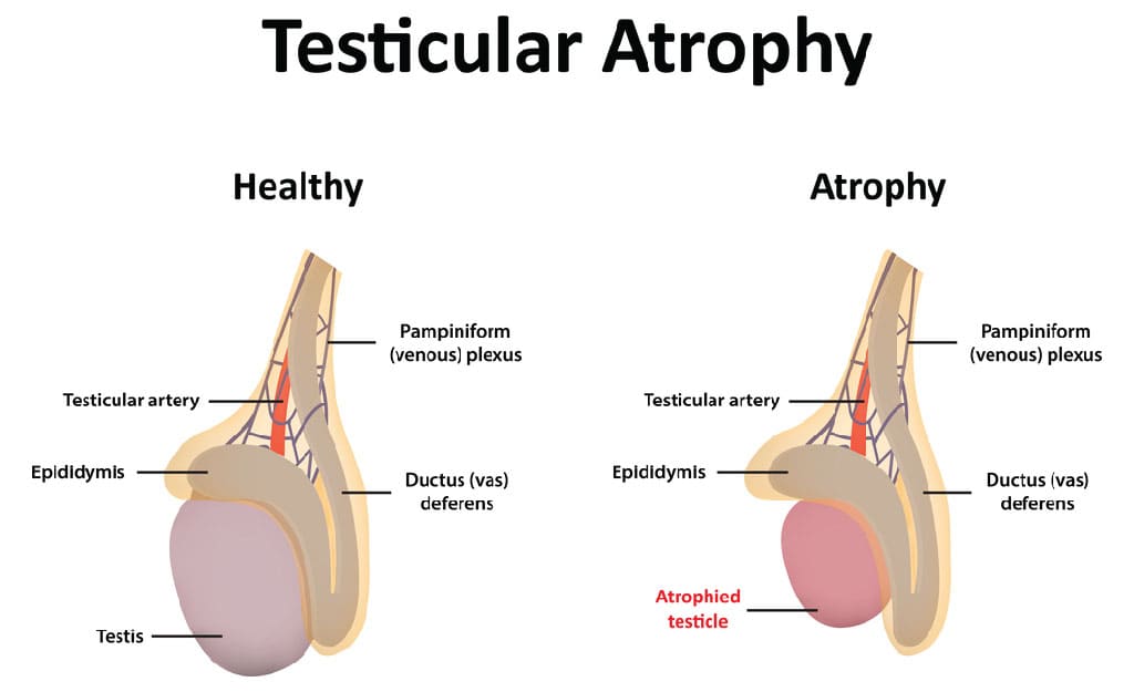 What is Testicular Atrophy