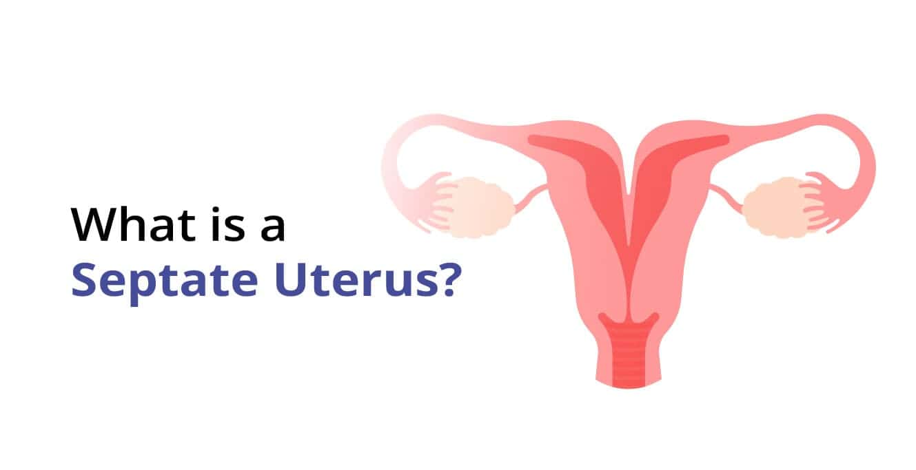 هڪ Septate Uterus ڇا آهي؟