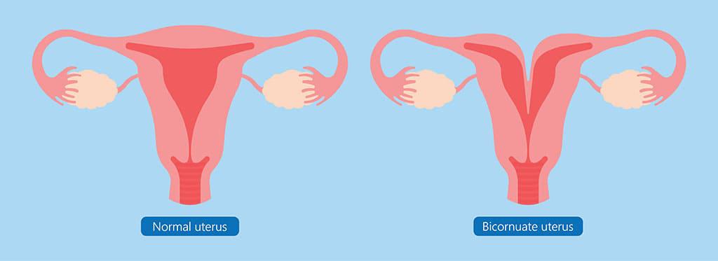 The Bicornuate Uterus: What You Should Know