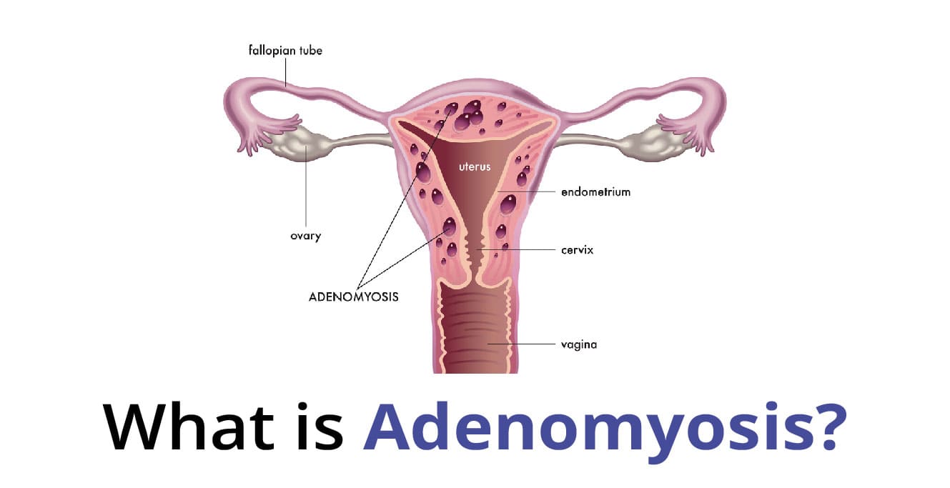 What is Adenomyosis