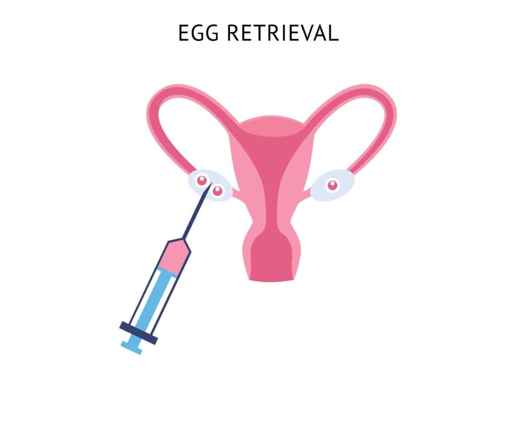 What to expect during the ovum pick-up