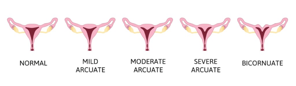 arcuate uterus scale