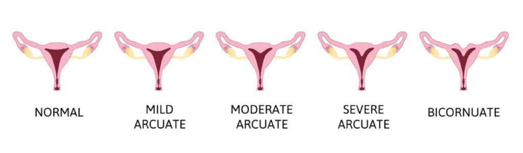 arcuate uterus اسڪيل