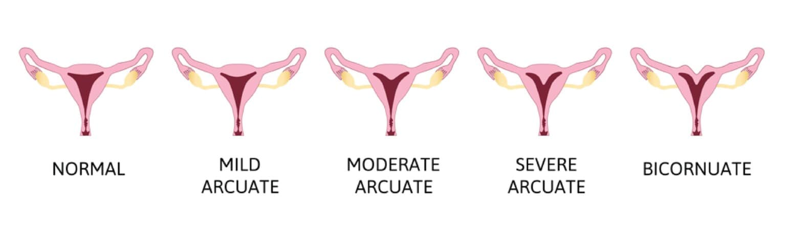 Arcuate Uterus: Causes, Symptoms and Treatments | Birla Fertility & IVF