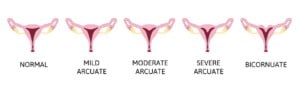 Arcuate Uterus: Causes, Symptoms and Treatments | Birla Fertility & IVF