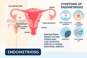 Medical infographic on endometriosis showing the female reproductive system with highlighted endometrial growths and labeled parts including fallopian tube, ovary, cervix, vagina, and endometrial lining. The right side lists symptoms such as heavy menstrual bleeding, severe menstrual cramps, infertility, and pain during sex with corresponding icons.