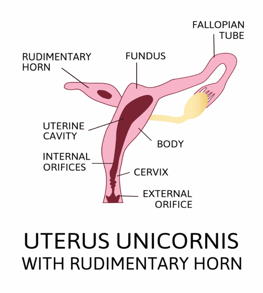 Unicornuate Uterus with Rudimentary Horn