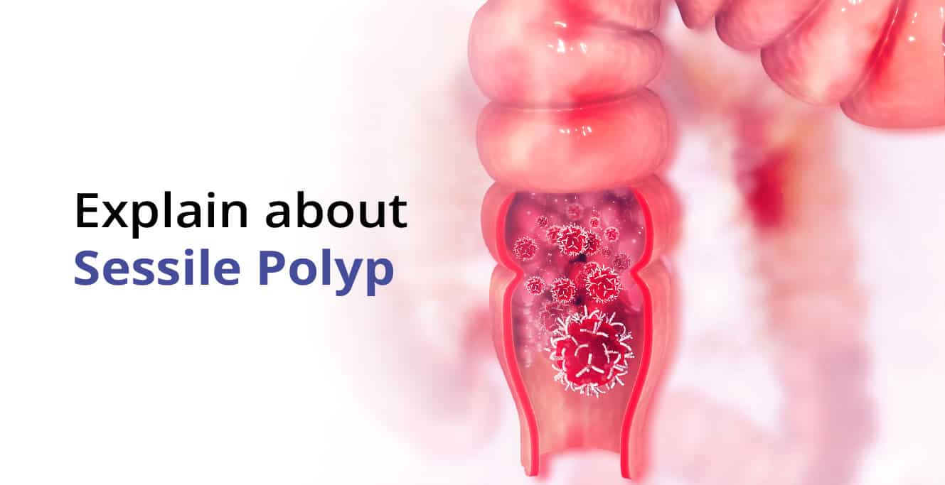 Sessile Polyp جي علامات، تشخيص ۽ ان جو علاج