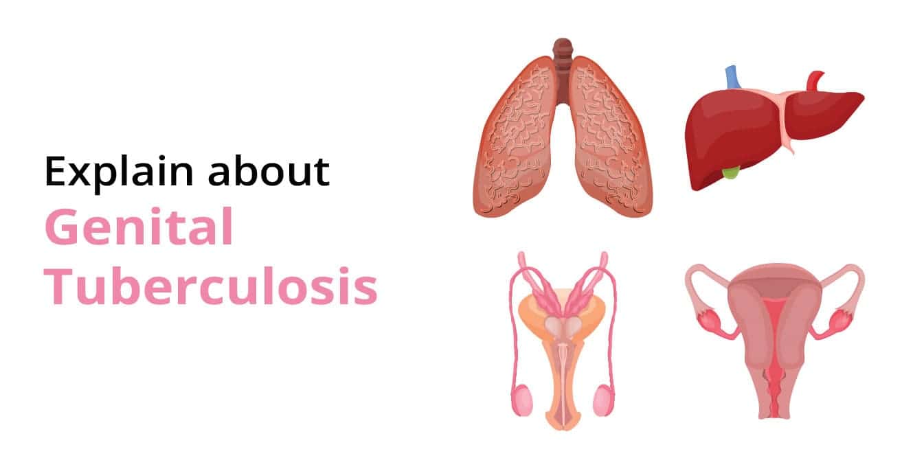 જીનીટલ ટ્યુબરક્યુલોસિસ શું છે? | કારણો અને લક્ષણો