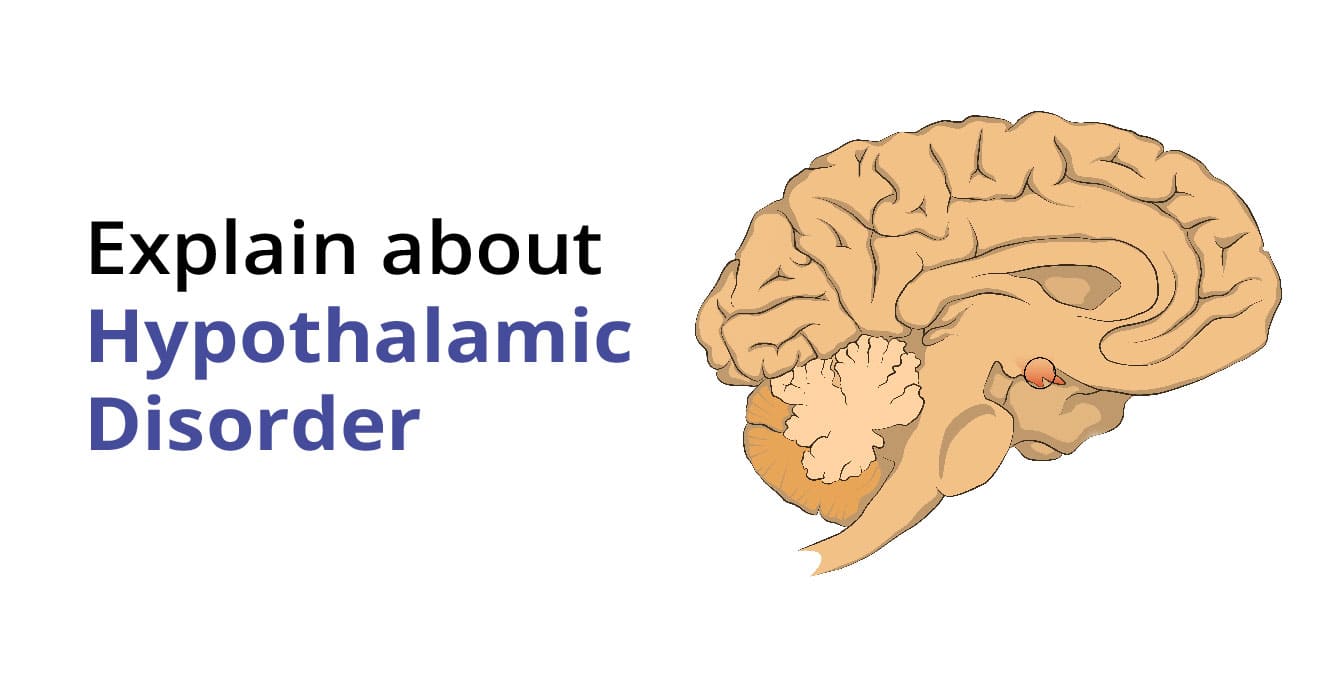 Hypothalamic Disorder ڇا آهي ۽ ان جا قسم؟