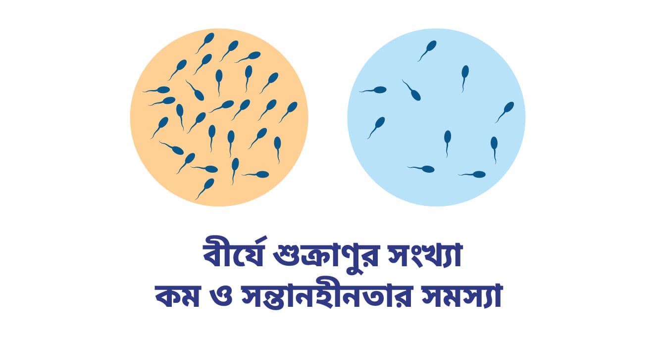 বীর্যে শুক্রাণুর সংখ্যা কম ও সন্তানহীনতার সমস্যা (Low Sperm Count in Bengali)