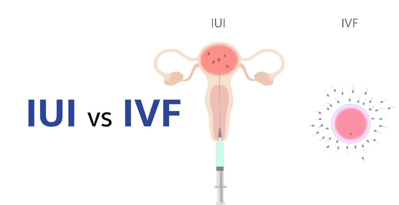 IUI بمقابله IVF: توهان لاءِ ڪهڙو صحيح آهي؟