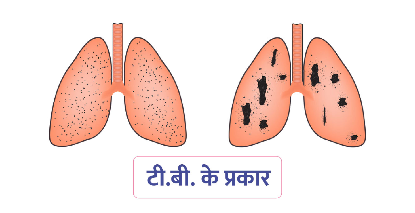 टी.बी. के प्रकार (Types of Tuberculitis in Hindi)