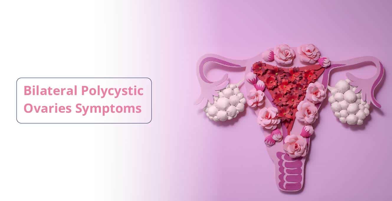 દ્વિપક્ષીય PCOS: લક્ષણો અને સારવાર