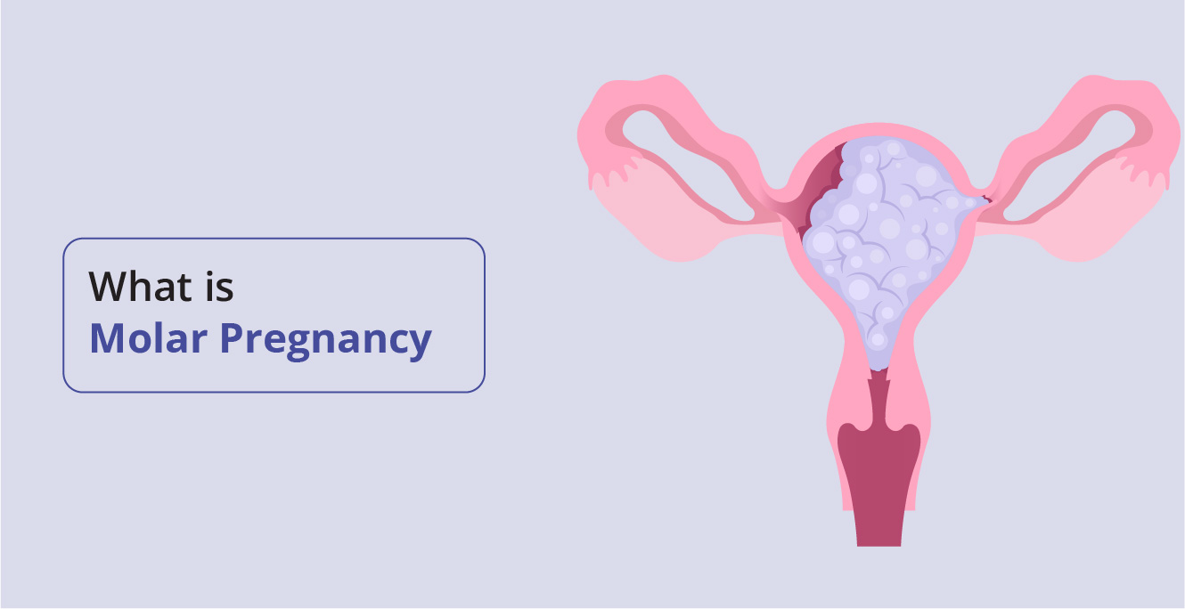 मोलर गर्भावस्था क्या है, और इसके कारण, लक्षण और उपचार